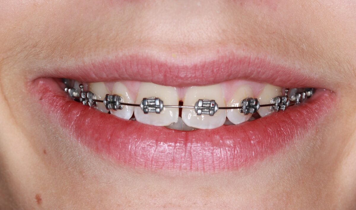 Crafting Smiles: The Role of Braces in Building Confidence and Comfort