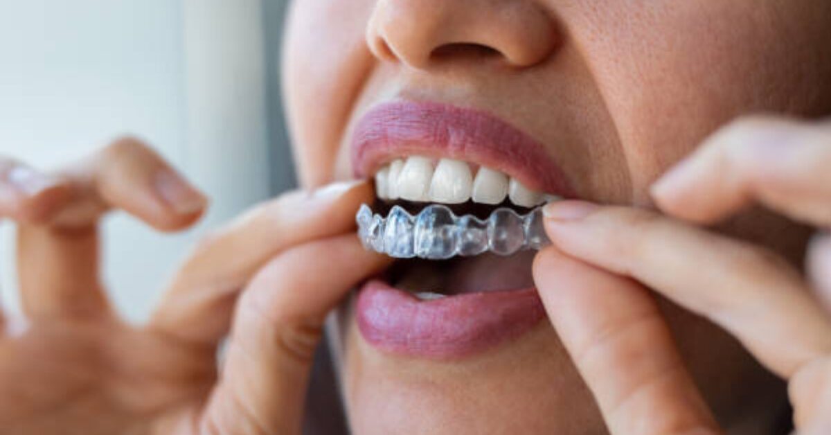 Crafting Your Desired Smile with Invisalign: A Personal Journey in Modern Dentistry